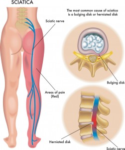 Sciatica Pain Medical Solution and Breakthrough